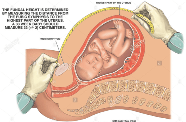 Low Dose Aspirin in the Prevention of Pre eclampsia and Fetal Growth Restriction Low Dose Aspirin in the Prevention of Pre eclampsia and Fetal Growth Restriction